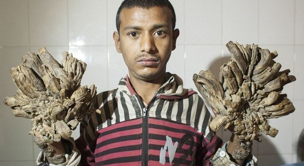 Bangladesh, il governo pagherà le cure mediche all'uomo-albero