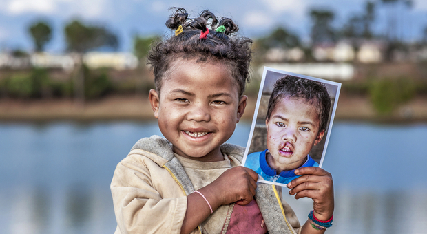 «Merry Smiles», al via la campagna natalizia di Operation Smile per fornire cure ai bambini con malformazioni del volto