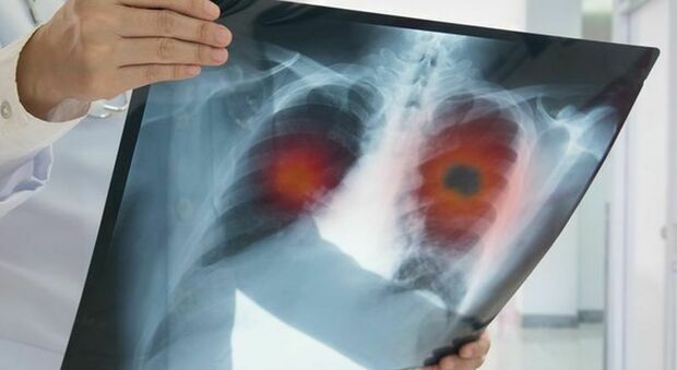 Tumore ai polmoni, un bando da 100mila euro per promuovere la ricerca indipendente con il progetto Research to Care di Sanofi
