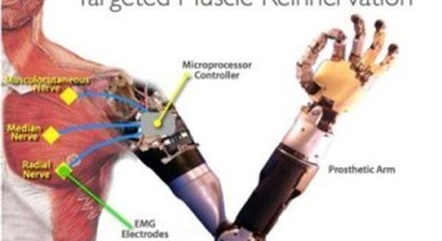 Braccio bionico al Campus di Roma per una donna: lo controllerà con il pensiero