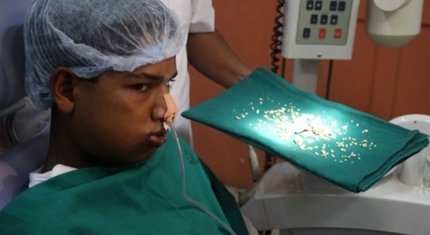 Medici estraggono 232 denti dalla bocca ​di un 17enne
