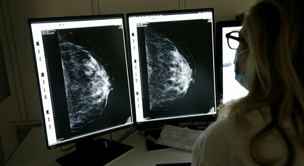 Tumore al seno, per alcune donne con il triplo negativo (ad alta mortalità tra le giovani) potrebbe non essere più necessaria la chemioterapia