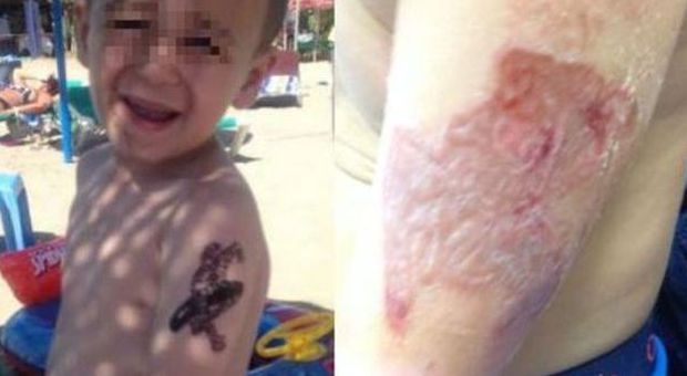 Reazione allergica dopo un tatuaggio all'Hennè: rischia la vita /Foto