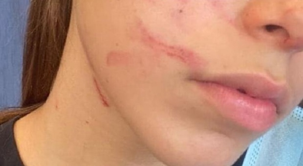 Ragazzina di 13 anni picchiata dai compagni di classe, il papà condivide la foto choc: «Pensavo che la scuola fosse sicura»