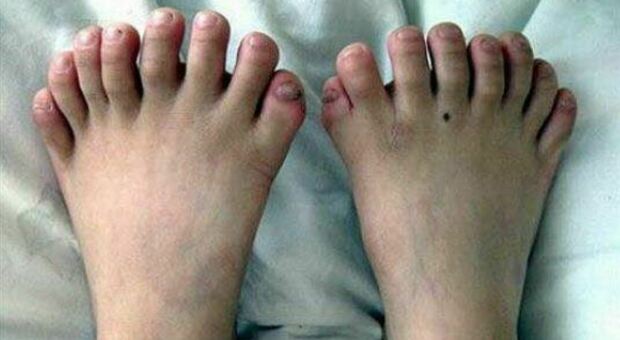 Bimba nasce con 26 dita tra mani e piedi: è affetta dalla polidattilia, una condizione molto rara. Foto generica