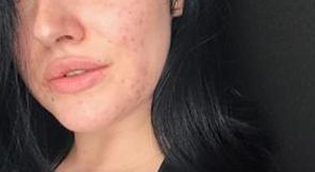 L'acne è così doloroso che non riesce a lavarsi e a uscire di casa: ventenne racconta la sua storia