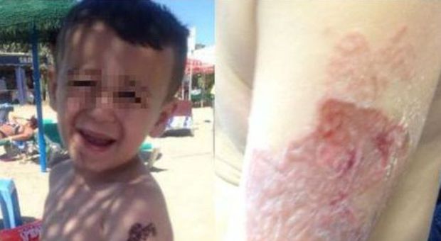 Reazione allergica dopo un tatuaggio all'Hennè: bimbo di tre anni rischia la vita