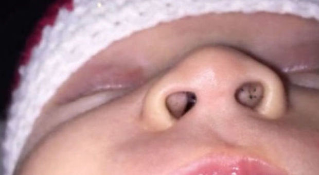 Le macchie nere nel naso del neonato