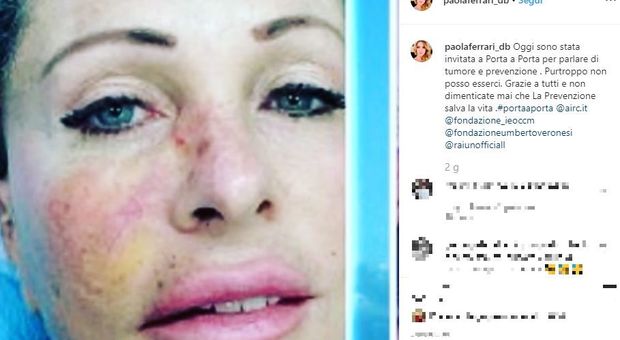 Paola Ferrari mostra i segni del tumore al viso: «La prevenzione salva la vita»