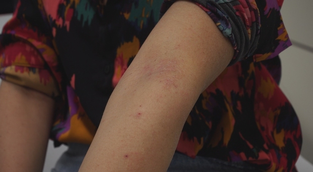 Dermatite atopica, nuova terapia da Napoli: stop al prurito e alle lesioni cutanee