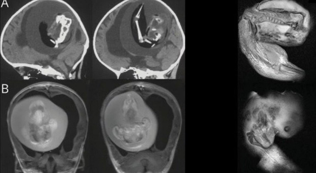Feto di un gemello rimosso dal cervello di una bambina di un anno: un caso su 500 mila