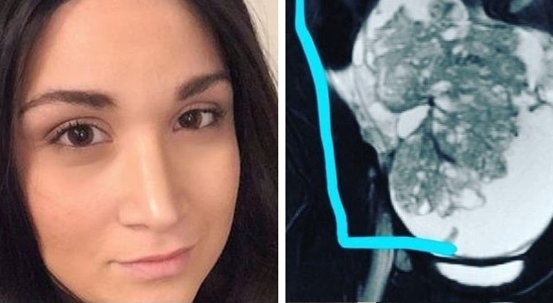 Ha forti mal di pancia, ma i medici minimizzano: ragazza scopre di avere il cancro alle ovaie