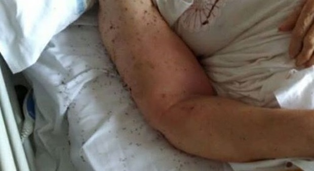 Napoli, formiche nel letto del malato task-force in reparto, stop ai ricoveri
