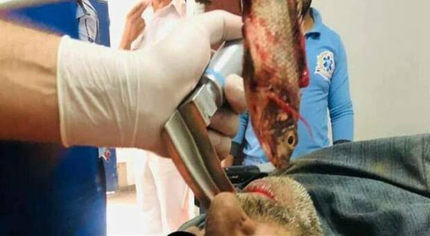 Chirurghi specializzati estraggono un pesce vivo dalla gola di un uomo