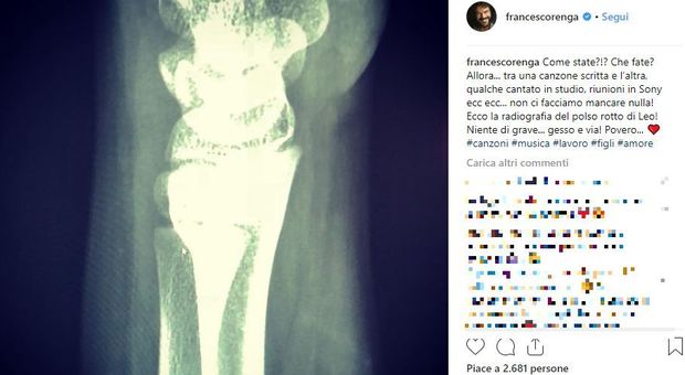 Francesco Renga, la radiografia su Instagram spaventa i fan: cosa sta succedendo