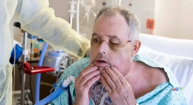 Storico trapianto di faccia per un 64enne: un'equipe di 100 chirurghi gli ha ridato il sorriso