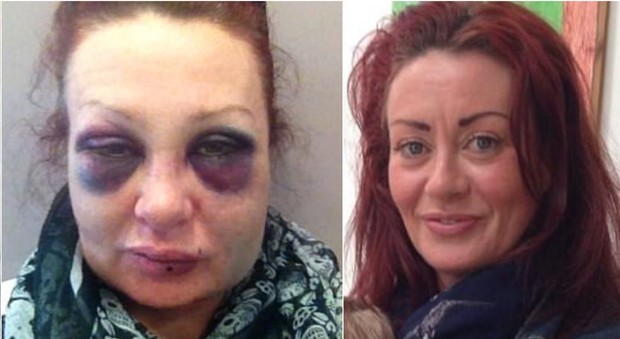 Inghilterra, un selfie al giorno per uscire dall'incubo: il calvario di Caroline dopo la violenza subita dall'ex