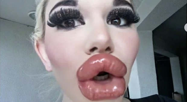 La donna con la labbra più grandi al mondo: 26 botox per diventare una bambola Bratz. Ecco chi è