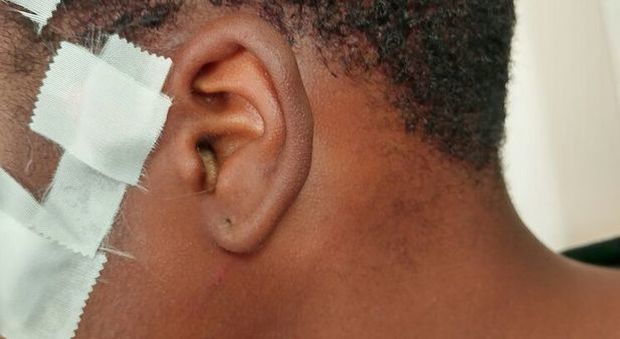 Napoli, lite tra compagni: 14enne ferito alla testa all’uscita di scuola