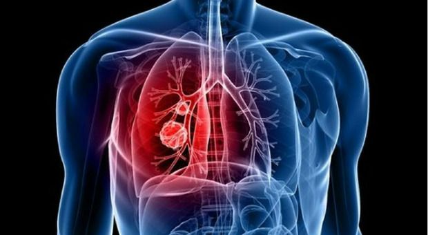 Tumore ai polmoni, primo vaccino testato su un uomo in Gran Bretagna: principio a mRNA come per il Covid