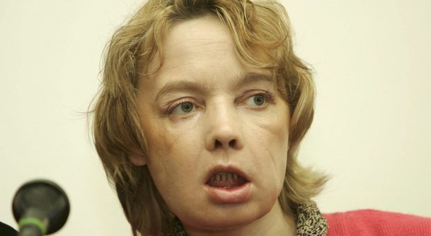 Morta Isabelle Dinoire, la prima donna al mondo a sottoporsi al trapianto facciale (AP)