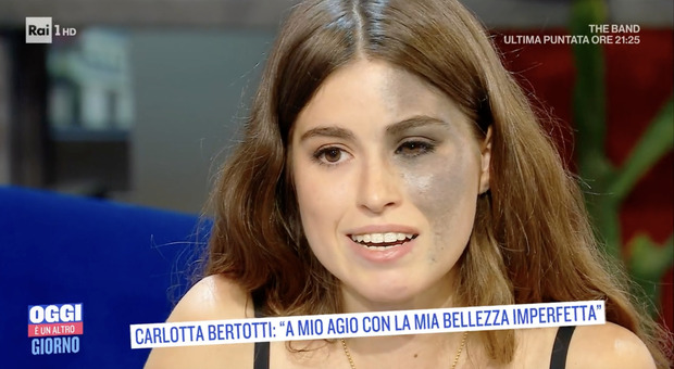 Carlotta Bertotti racconta a Serena Bortone tutta la sua malattia