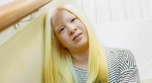 Xueli Abbing, albina abbandonata in un orfanotrofio, ora è una top model