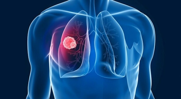 https://statics.cedscdn.it/photos/MED/2025/06/06/8882681_06170023_tumore_polmoni_cancro_motivi_non_fumatori_inquinamento_geni_oggi.jpg