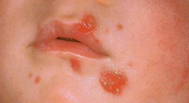 https://statics.cedscdn.it/photos/MED/2025/06/10/8889920_10164938_herpes_labiale.jpg