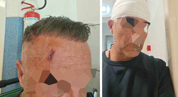  Non ha il biglietto, aggredisce l'autista del bus e gli spacca la testa 