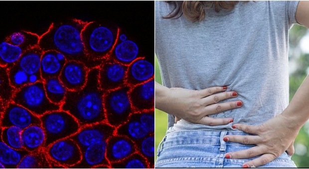 Tumore pancreas, come capire se il mal di schiena è un sintomo. L'oncologo: «Ecco quali sono i segnali da considerare» Tumore pancreas, come capire se il mal di schiena è un sintomo. L'oncologo: «Ecco quali sono i segnali da considerare»