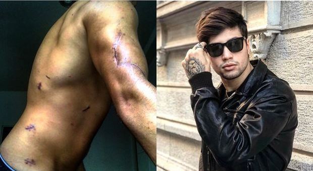 Niccolò Bettarini mostra le sue cicatrici su Instagram