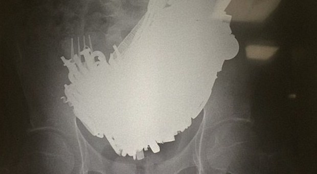 L'immagine a raggi X dello stomaco del paziente (copyright Zululand Observer)