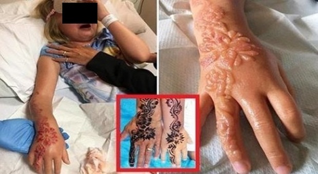 Bimba ustionata per un tatuaggio all'hennè fatto in vacanza: resterà sfigurata a vita