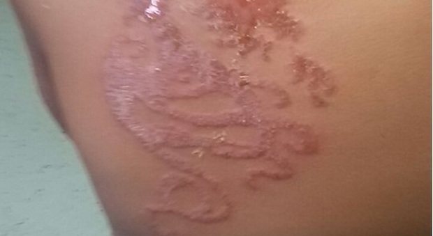 Una moda che può creare problemi Attenzione ai tatuaggi con l'hennè