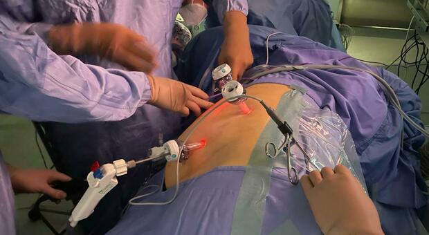 Tumore congelato e asportato in sala operatoria: “salva” una donna di 61 anni