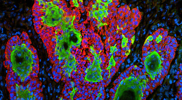 Tumori, dalla genetica le nuove armi per combattere le recidive Tumori, dalla genetica le nuove armi per combattere le recidive
