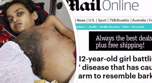 Bimba di 12 anni si sta trasformando in un albero: "Sul braccio crescono i primi parassiti"