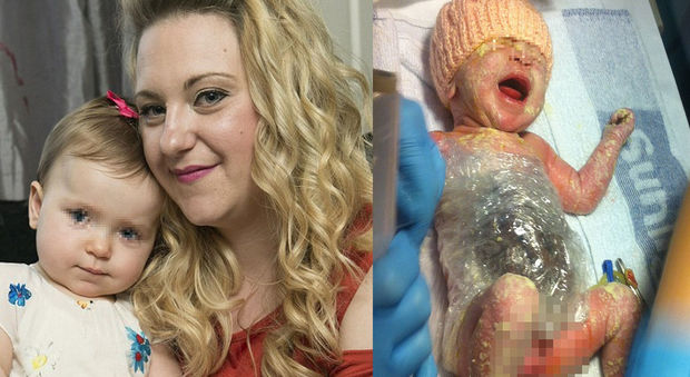 Bimba nasce con gli organi fuori dall'addome, i medici la salvano con la pellicola trasparente