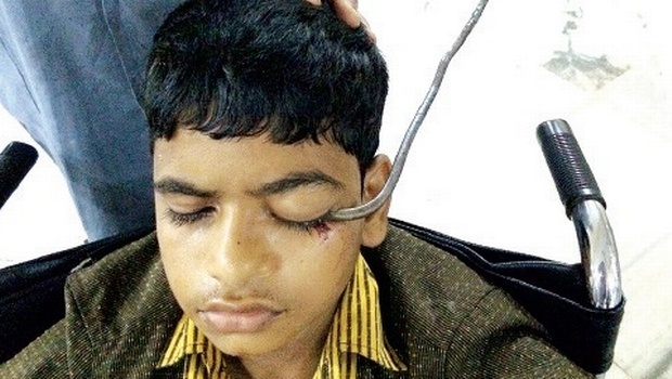 India, gli si conficca un gancio da macellaio nella cavità orbitaria: l'intervento dei medici gli salva l'occhio