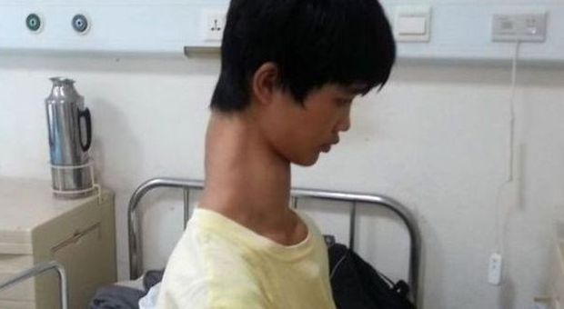 Ha il collo più lungo del normale: l'inferno del 15enne con tre vertebre in più | Foto