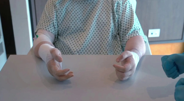 Operaio perde entrambe le mani, i medici le reimpiantano: «Fondamentale la tempestività». È il primo caso in Italia