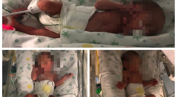 Grande festa all'ospedale Di Venere: nascono tre gemelli