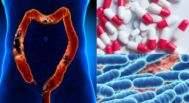 Individuate le cause dell'aumento del cancro al colon tra gli under 50: infenzioni fungine, antibiotici, dieta grassa e diabete di tipo 2