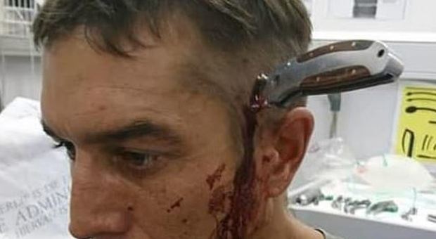 «C'è un dottore libero?»: ciclista si presenta in ospedale con un coltello conficcato in testa