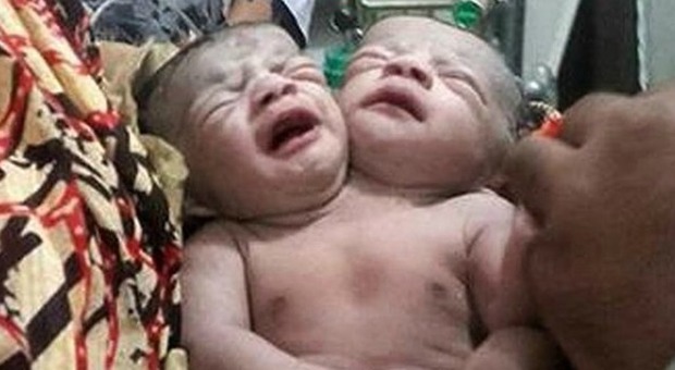 Bimbo con due teste nato in Bangladesh: la folla dice che è un 'miracolo'