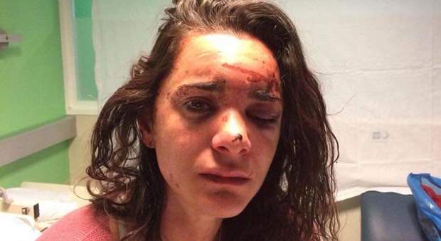 Ragazza americana violentata a Madrid, le foto choc su Fb: «Ho dovuto fingermi morta»