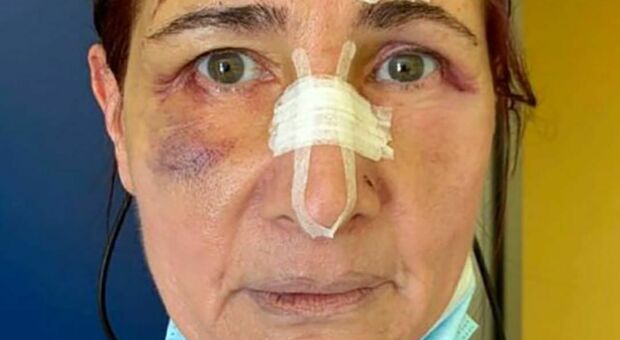 Chiede di indossare la mascherina, infermiera picchiata da un immigrato a Foggia
