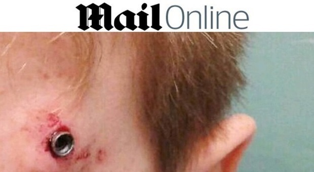 Ragazzino di 11 anni colpito in testa da un piombino: la foto choc sui media inglesi