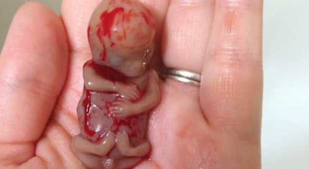 La foto del bambino abortito a 11 settimane